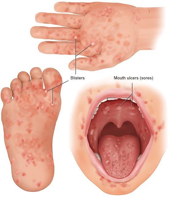 Hand Foot And Mouth Cases Rising- 66 Cases Recorded